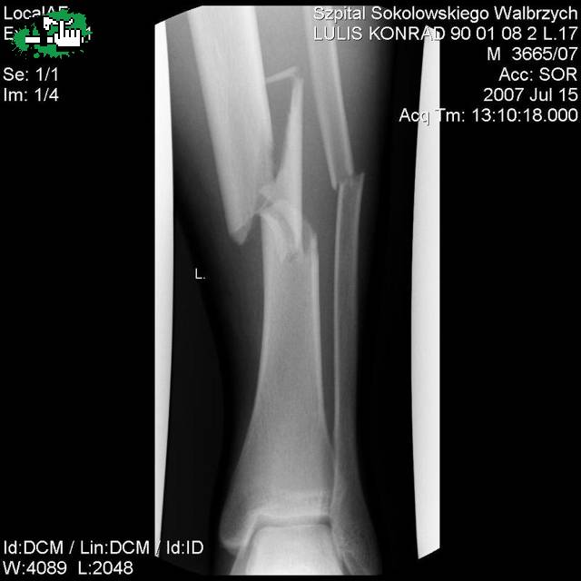 Broken leg 2