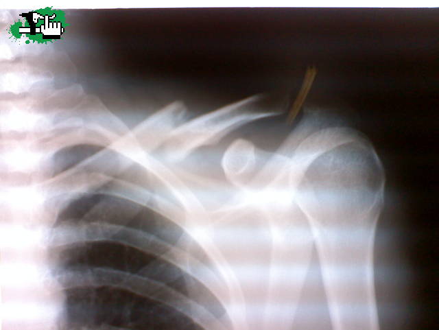 CLAVICULA DE TONGA 
