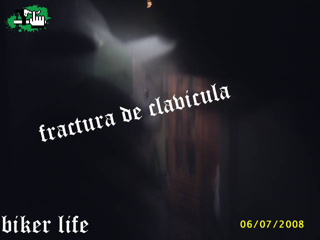 fracturaaa