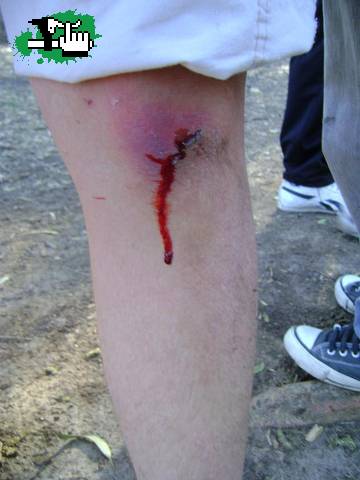 asi me quedo la rodilla!!