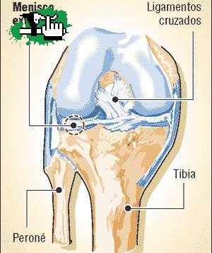 Lesion de los Meniscos