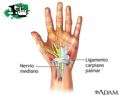 ayuda tendinitis