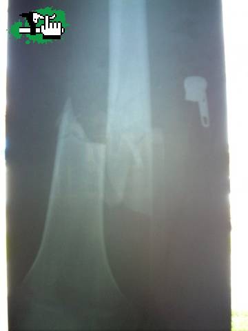 mi femur!!! igual no duele!
