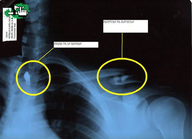fractura de clavicula