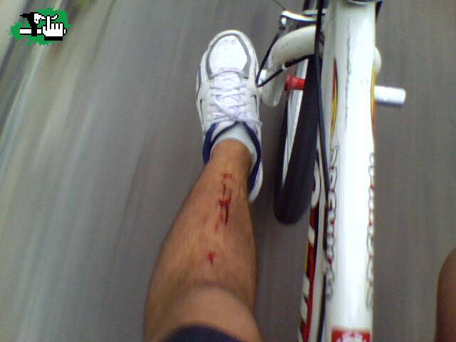 La pierna algo golpeadita por intentar el salto mas alto que podia, pedalazo en la canilla 