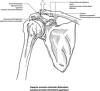 foto de Luxacion acromioclavicular... Que tal!!!